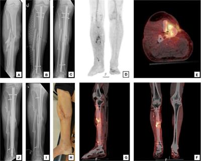 Bones on fire: illuminating osteomyelitis through the radiant lens of 18F-FDG PET/CT